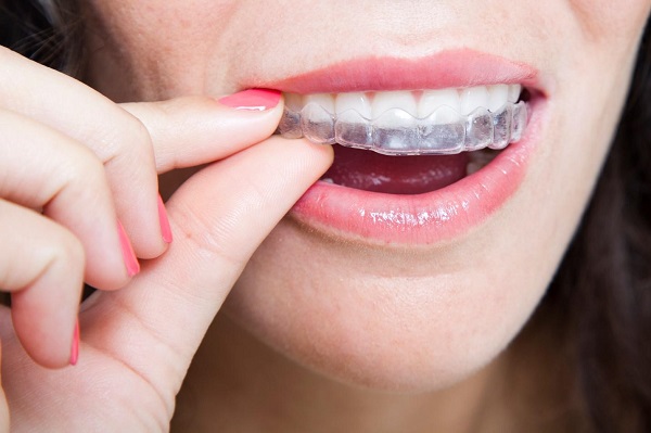 Quy trình niềng răng tháo lắp diễn ra như thế nào?