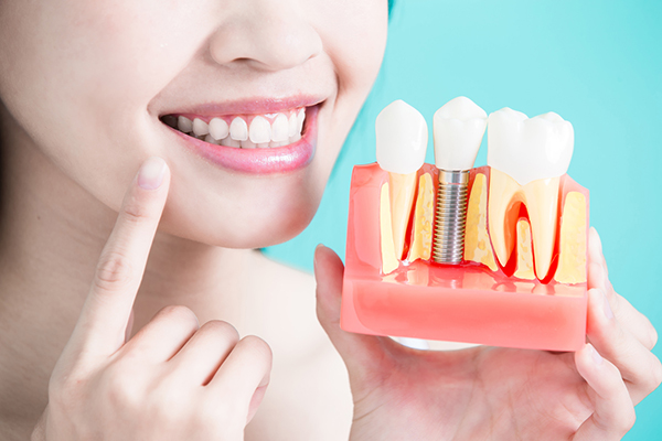 Trồng răng Implant là phương pháp cấy trụ chân răng vào xương hàm để tái tạo lại hàm răng đã bị mất răng hoàn toàn